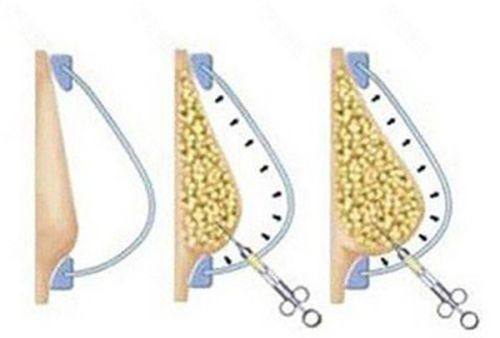 六、线提升隆鼻失败修复:先取线再修复是关键