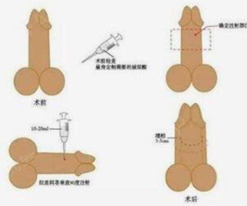 四、硅酮凝胶+激光:助力手术暗红色疤痕快速消退的关键护理