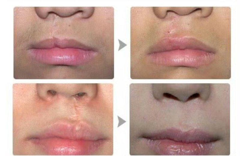 三、白毒瘦脸针好吗