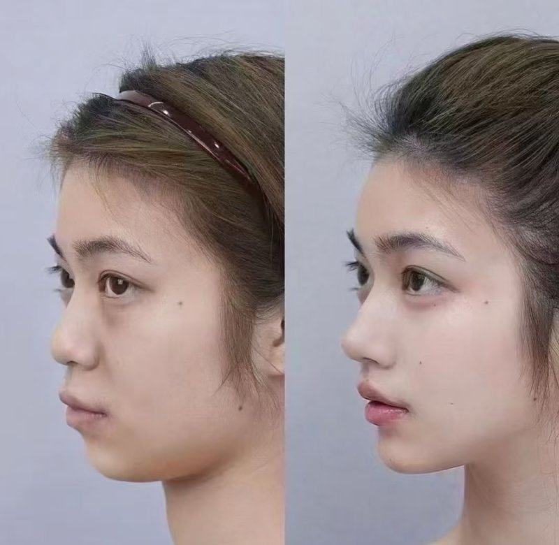 四、后悔想取出?得看取出时机和操作规范