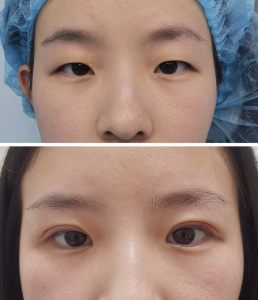 三、土豆能去眼袋浮肿吗？针对假性眼袋有一定可能