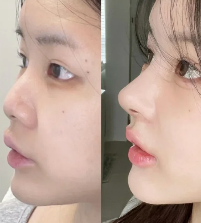 三、腹部吸脂可能遗留的后遗症