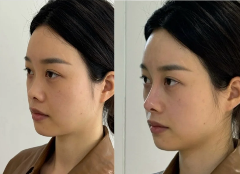 四、哪些不当操作会放大腹部吸脂的危险