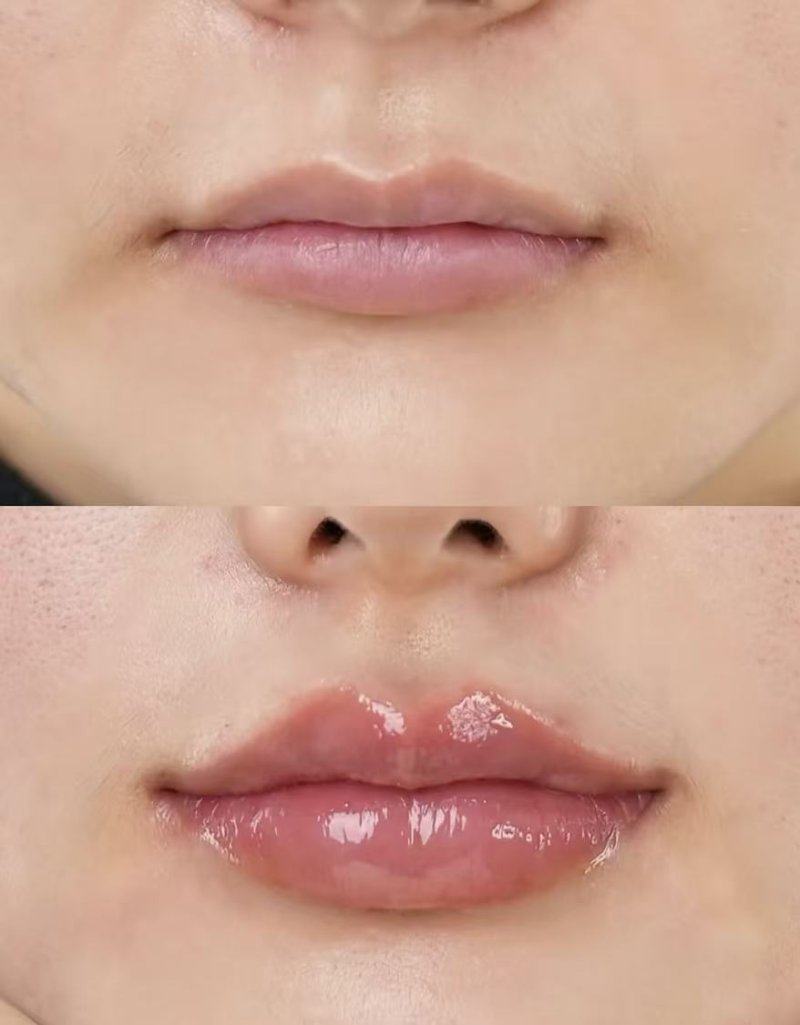 三、手术后疤痕红色多少天可以退去?为什么有的消退慢?