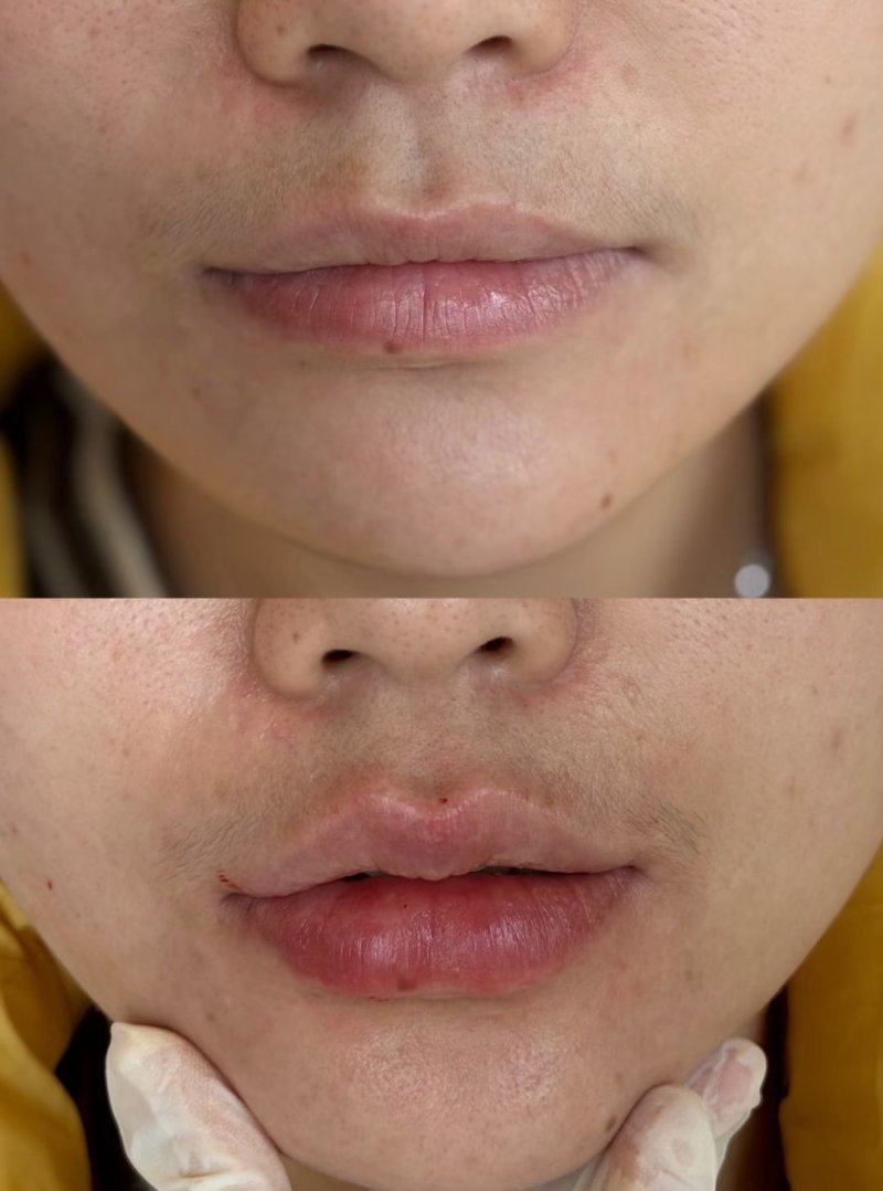 四、土豆真的可以去眼袋淡化皱纹么？别对“淡化皱纹”抱期待