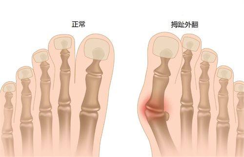 二、小腿抽脂的常见潜在副作用与危害盘点