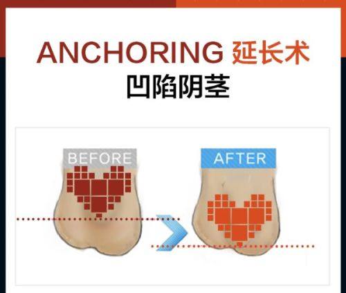 四、假体变软异常情况的应对