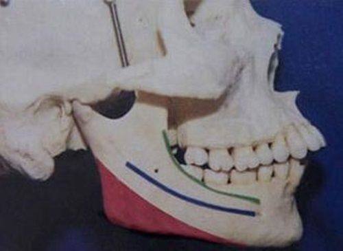 三、手术相关因素:埋线时长的“技术支撑”