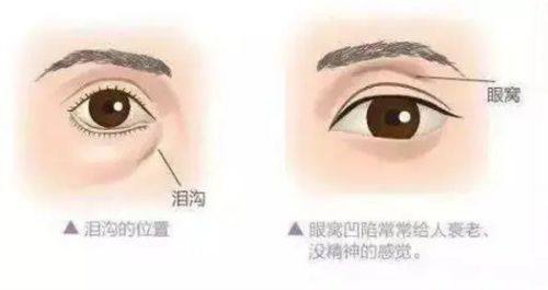 二、除皱针一次注射的起效时长：不同产品有差异