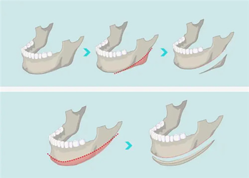 三、兼顾眼袋与皱纹的联合改善策略