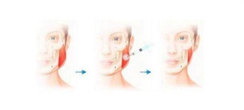 五、医美祛眼袋价格区间与避坑指南