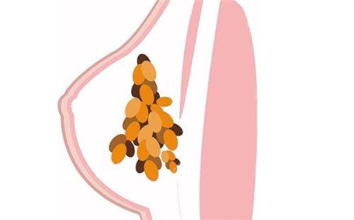 五、长期脂肪型/真性眼袋:医美手段直击问题