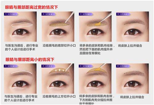 五、关于除皱针一次注射的常见误区澄清