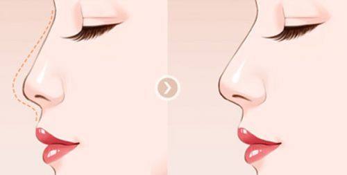 二、眼袋能去除吗?有什么小窍门?