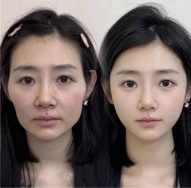 六、降低小腿抽脂风险的核心要点:术后严格遵循护理要求