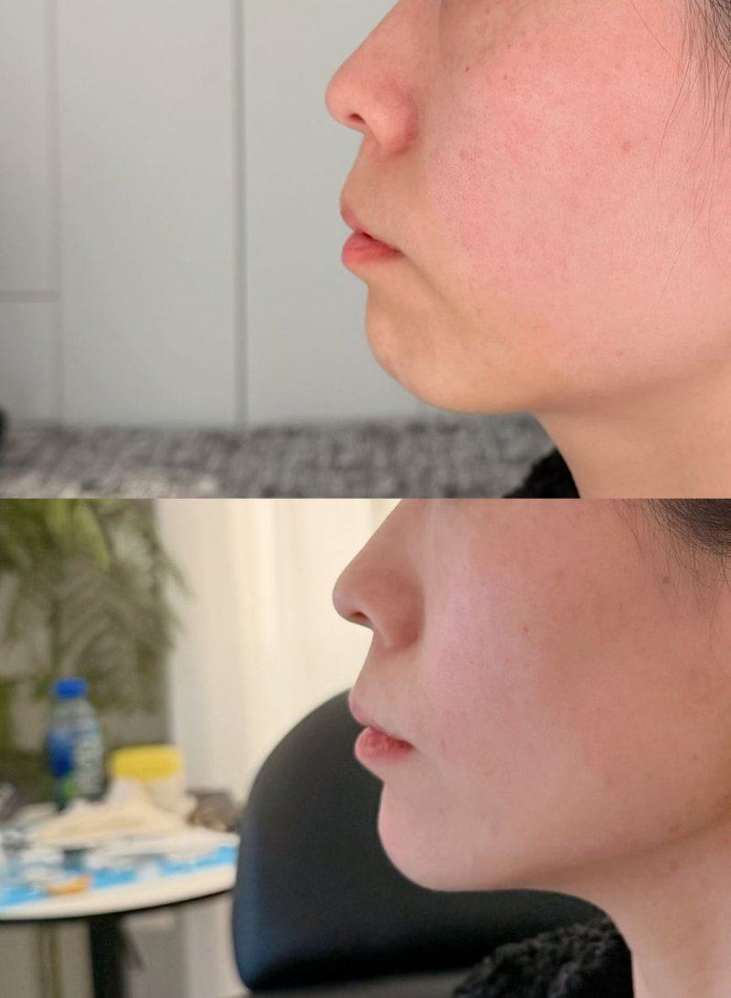 三、偶尔生理性浮肿:即时缓解小妙招