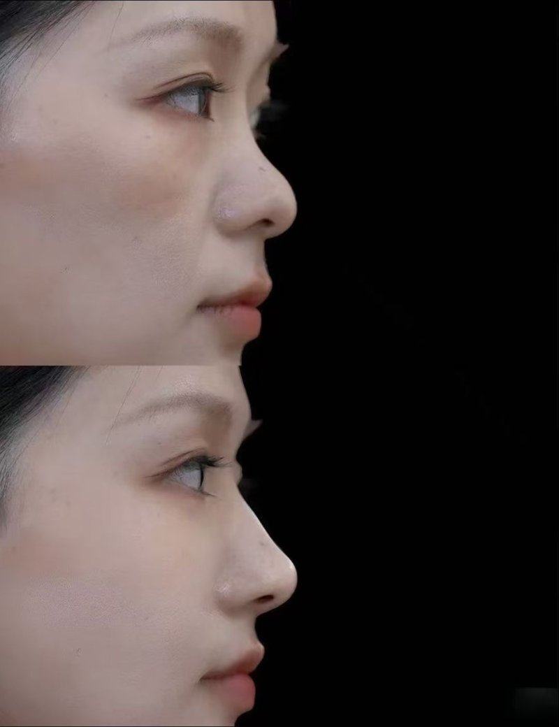 六、凸起疤痕祛除的关键注意事项