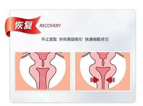 三、传统双眼皮术式怎么选才“好”?看基础与需求匹配