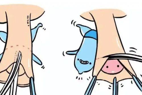 二、2025年主流新型精细化眼综合术式对比,选“好”的术式看差异