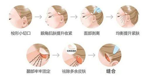 五、割双眼皮后可以趴着按摩吗
