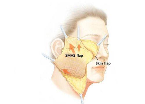 三、避坑第二招：选对手术年龄，适配眼部修复节奏