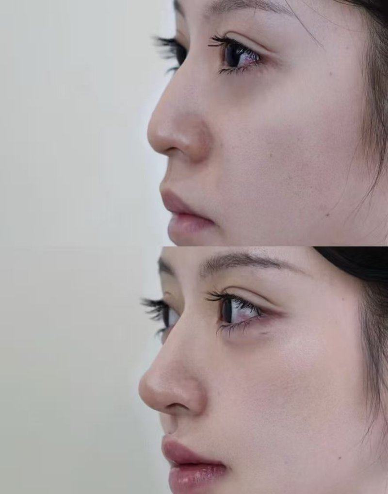 四、割完双眼皮可以趴着玩手机吗