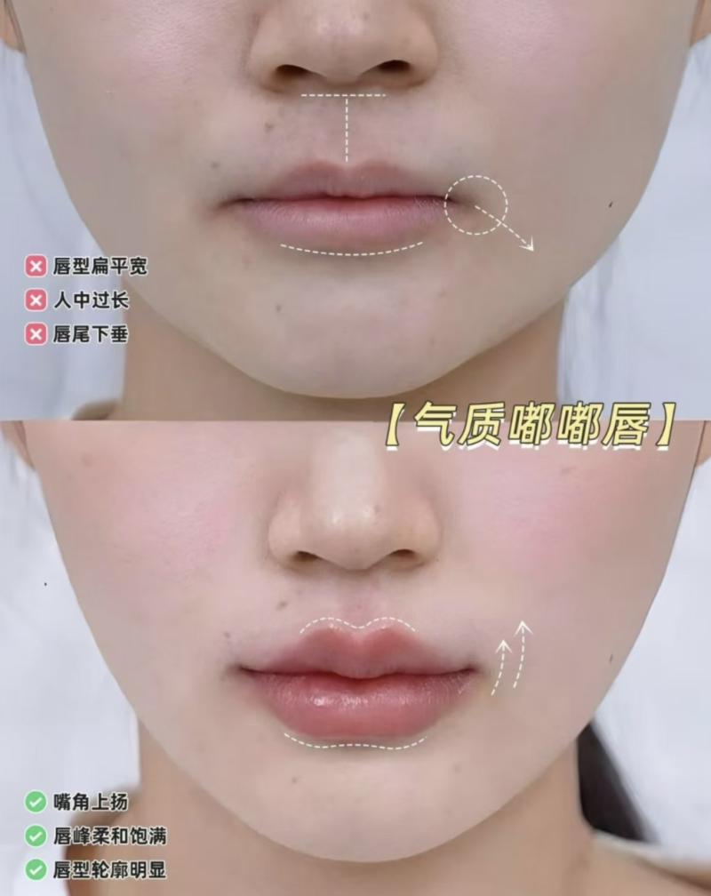 二、做完双眼皮趴着有哪些具体影响