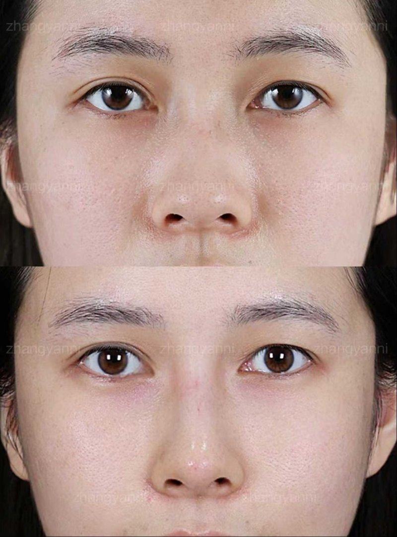 五、如何合理规划外切眼袋手术的时间与修复