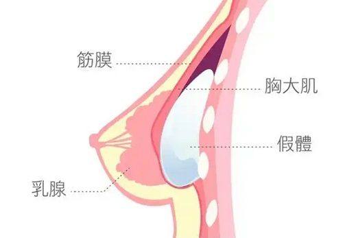 三、5毫米双眼皮成效:理想形态与实际局限