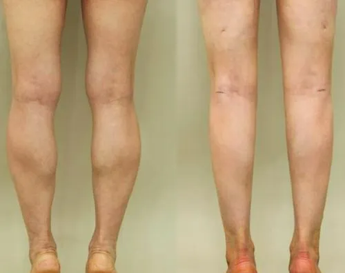 二、隆鼻5天发现鼻小柱歪斜的紧急补救办法