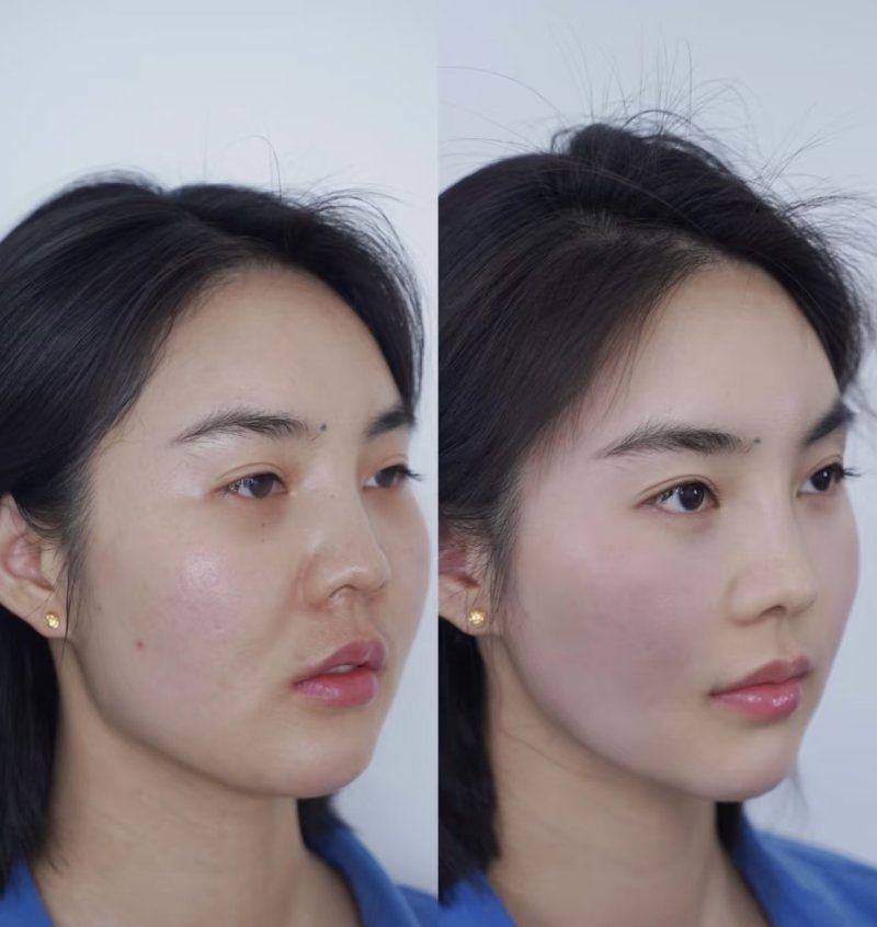 四、打了瘦脸针多久可以瘦下去：成效高峰与至佳状态的区别