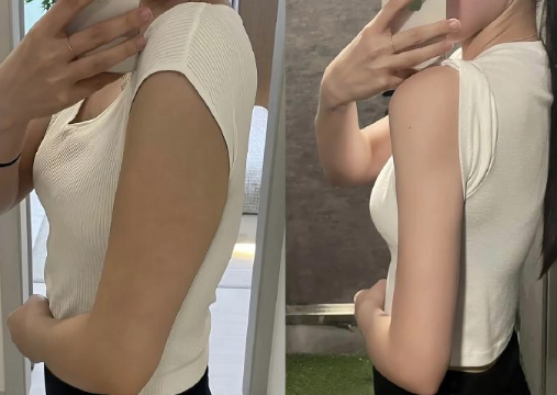 四、大腿抽脂的安心抽脂量提醒