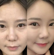 二、全切双眼皮术后玩手机有哪些影响