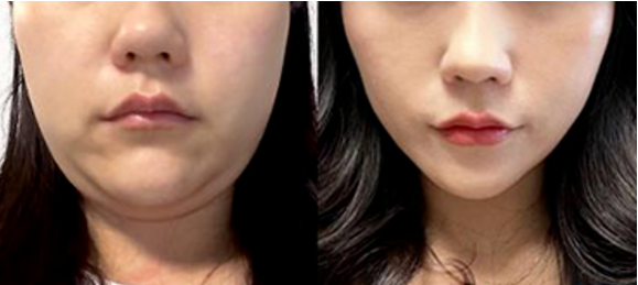 三、打了瘦脸针多久有变化：从咬肌软到脸型精致的递进