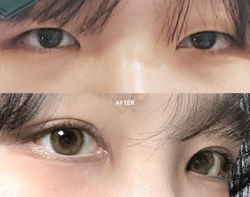 四、假体隆胸的真实感受与常见顾虑