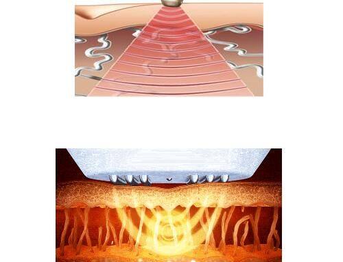 如何较大化延长耳软骨隆鼻的维持时间