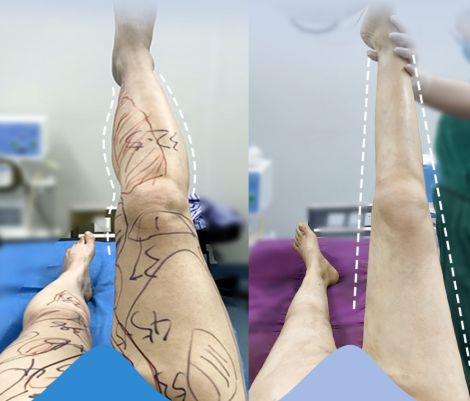 五、肿眼泡全切双眼皮多少钱及避坑技巧