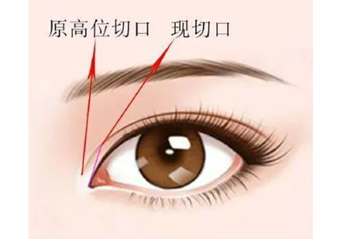 五、如何降低双眼皮手术的不良影响