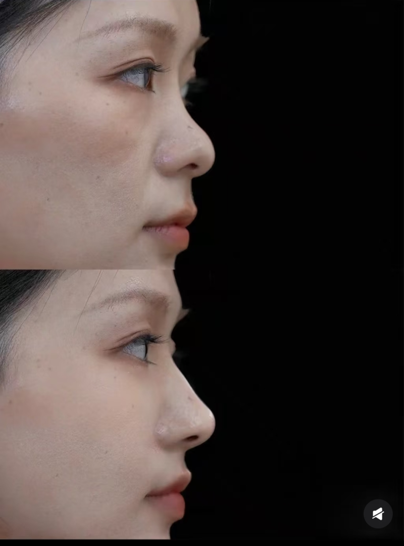 二、肿眼泡适合做哪种双眼皮