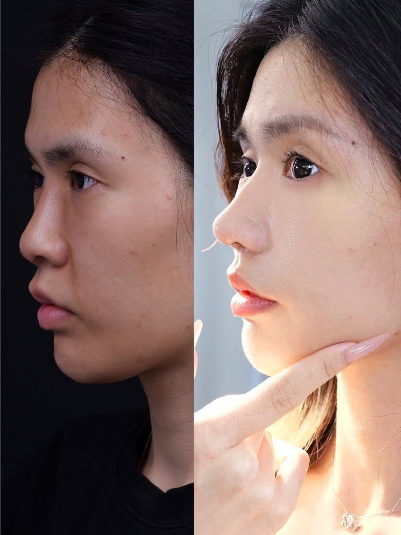 三、双眼皮手术对以后的长期影响