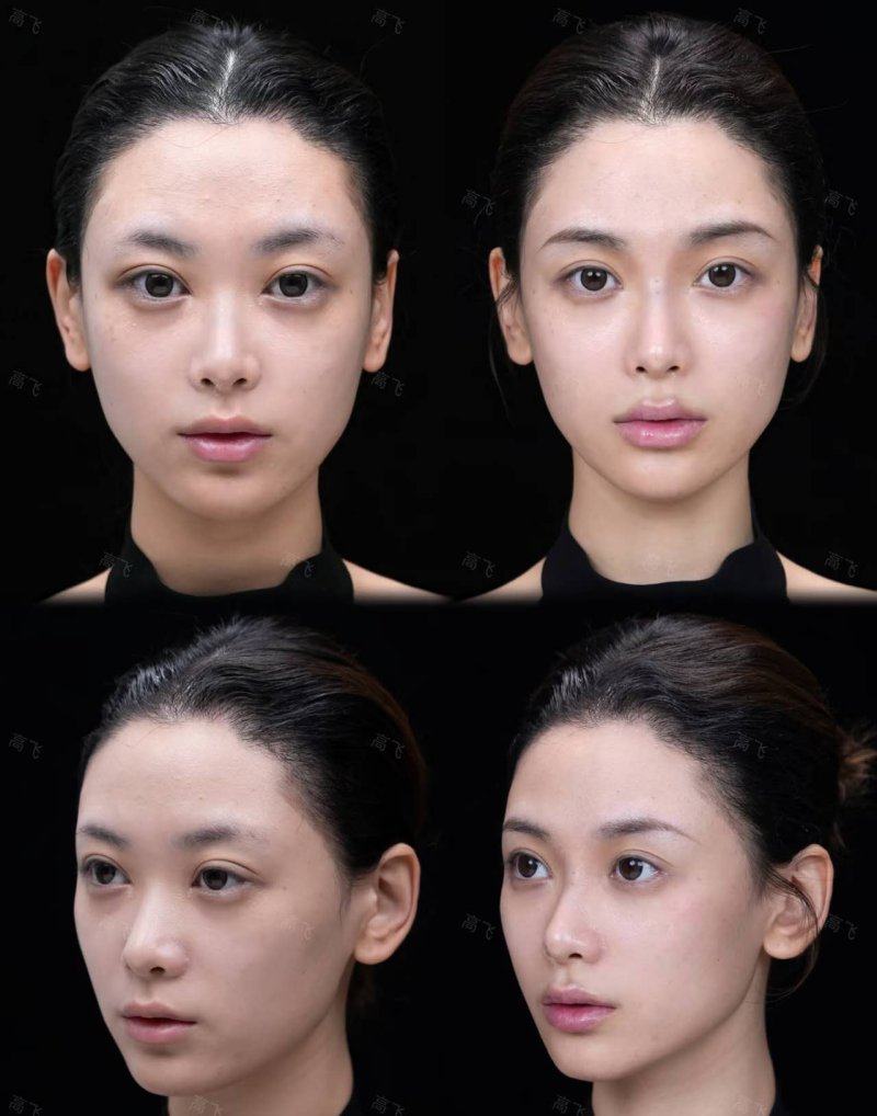 四、影响切眼袋修复速度的关键因素