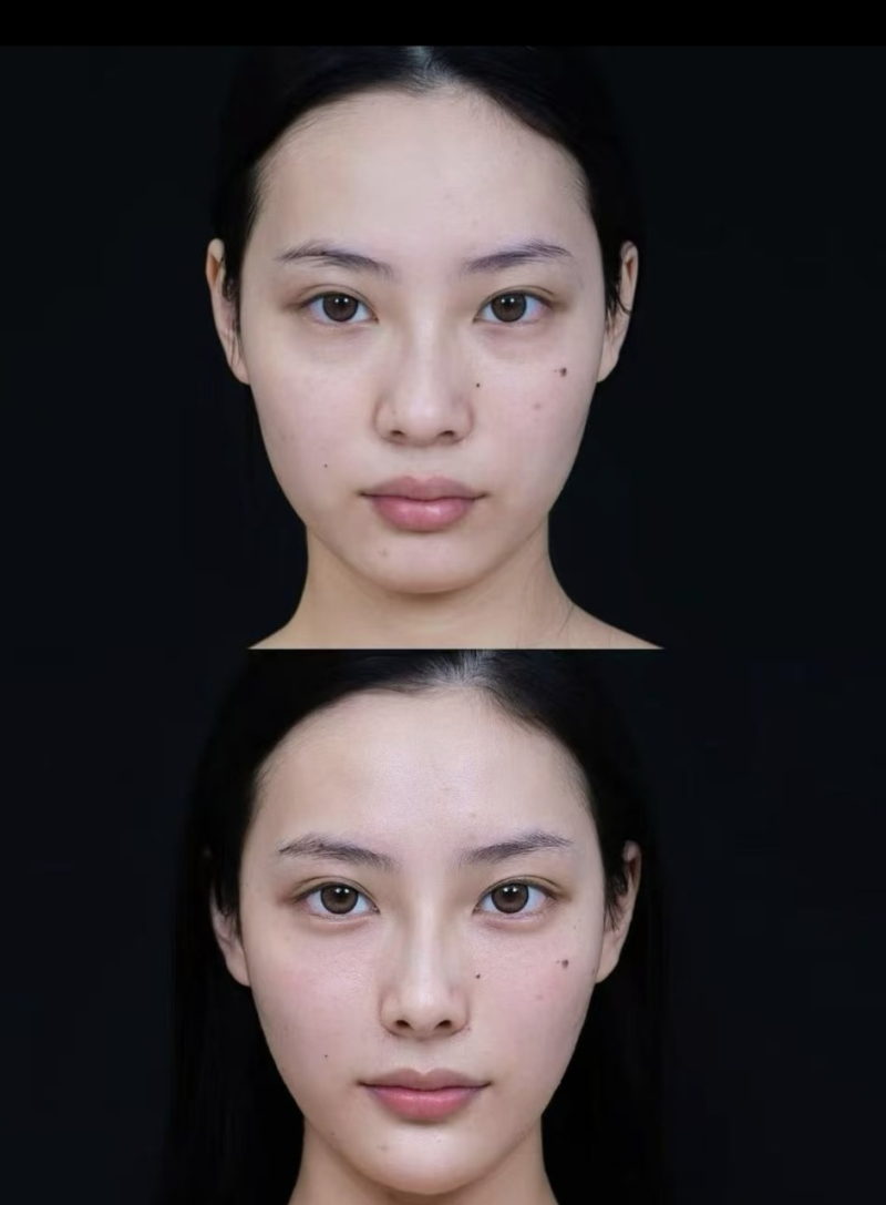 四、长期顽固眼袋浮肿,医美干预的科学选择