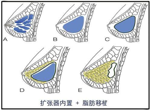 五、手术缝针类疤痕的激光治疗选择