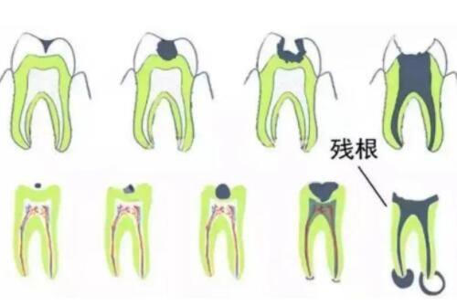 二、激光去眼袋怎么去除更有成效——选对适配人群是关键