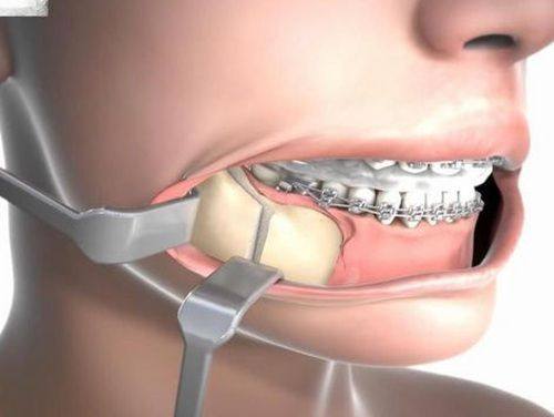 术后修复的关键核心提示