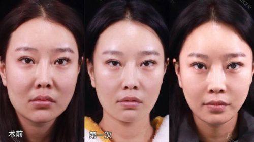 四、激光去眼袋的优缺点与风险提示