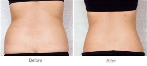 二、眼袋和黑眼圈怎么祛除更有效:分类型定制医美方案