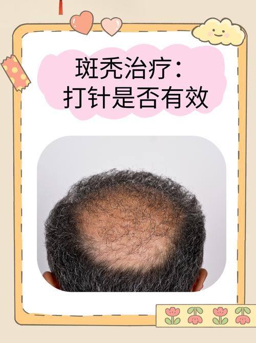 广州瑞丽诗植发医院擅长项目: