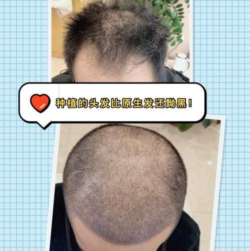 广州瑞丽诗植发医院价格表: