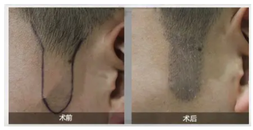 广州科发源植发中 心口碑评价：